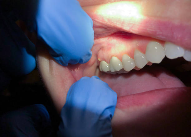 Best Emergency Denture Repair in Cypress Lake, FL