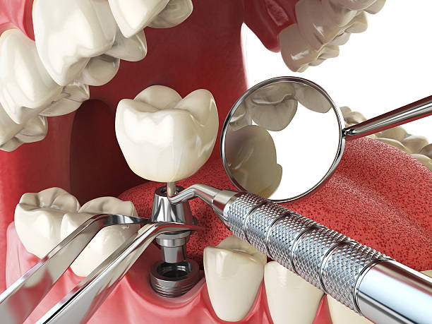 Best Dental Abscess Treatment in Cypress Lake, FL
